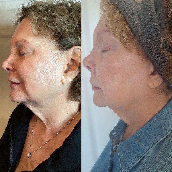 Botox