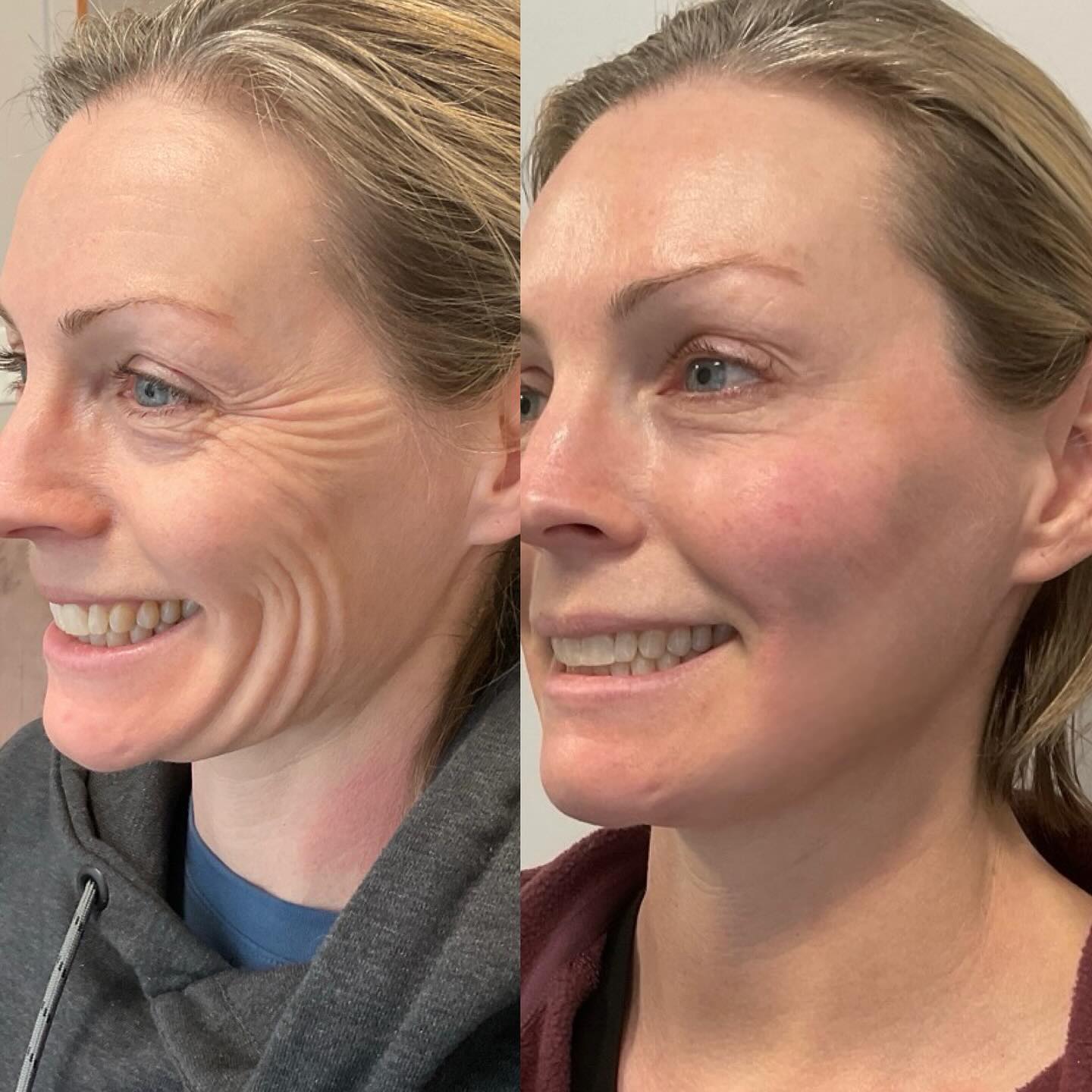 Botox