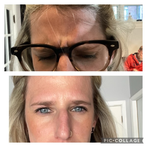 Botox Before and After