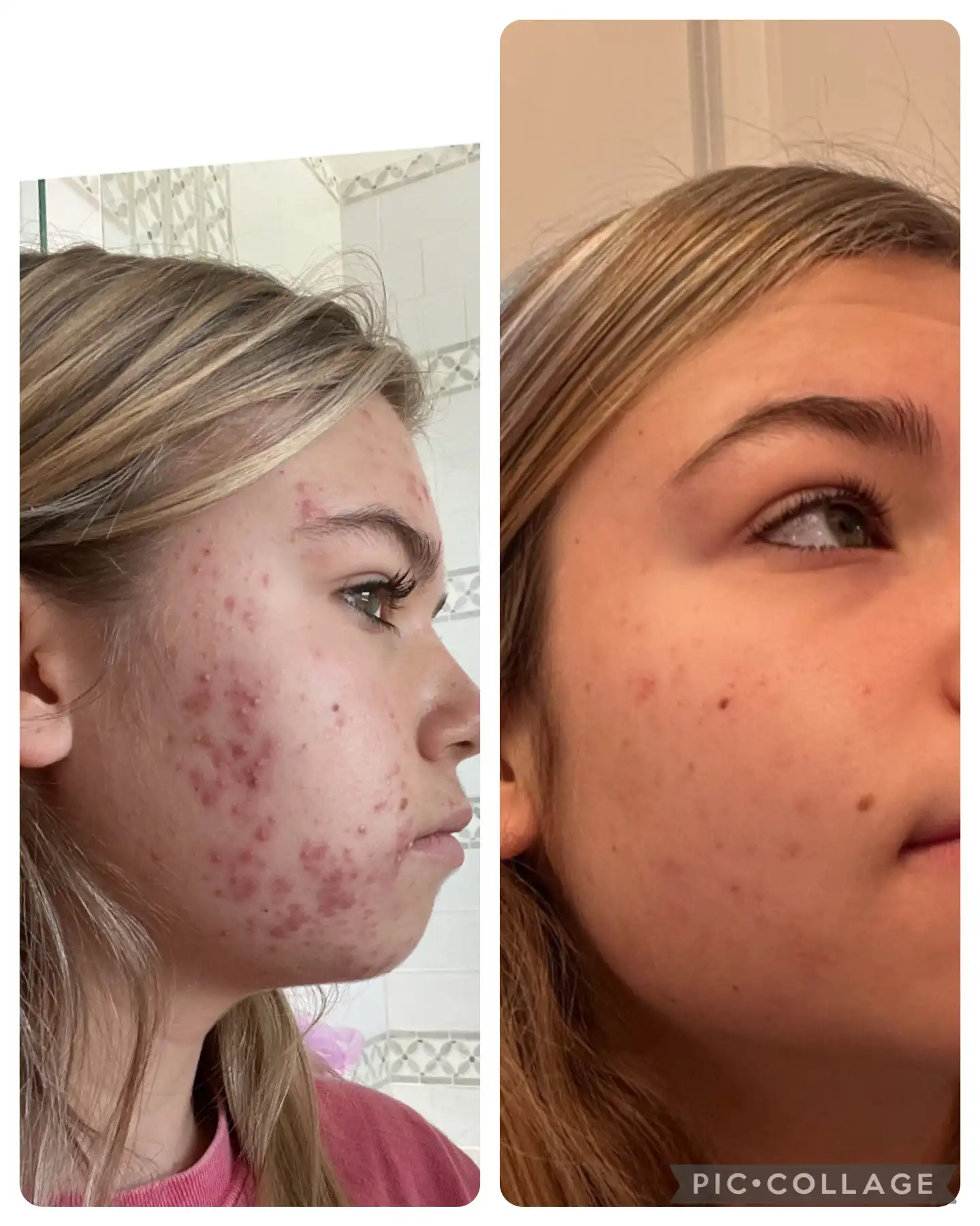 Acne Treatment Before and After