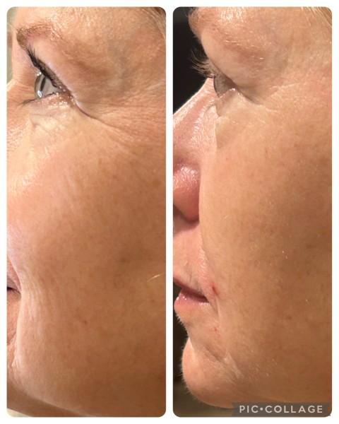 Facial Treatment Before and After