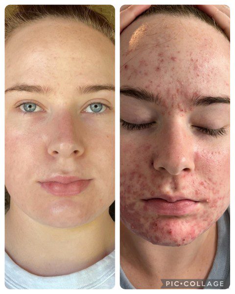 Facial treatment